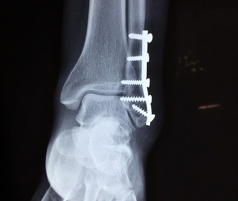 Convalescente dagli incidenti in ballerine e scarpe da punta